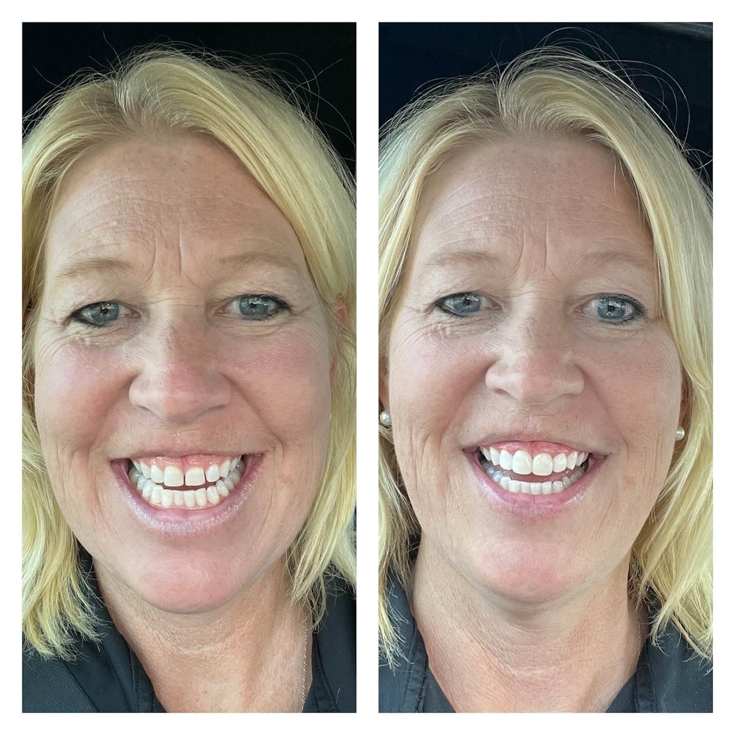 What is Bioclear and Why Are Patients Raving About It?